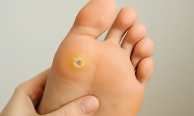 Gros plan sur une verrue plantaire, montrant la texture et la couleur. L'acide salicylique est souvent utilisé pour traiter ce type de verrue.