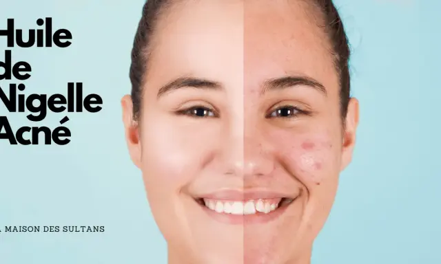 Visage divisé montrant une peau nette et une peau acnéique, avec le texte "Huile de Nigelle Acné".