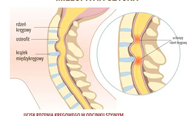 Objawy neurologiczne kręgosłupa szyjnego: kiedy to poważne?