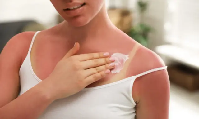 Une femme applique une crème apaisante sur son coup de soleil. Le Cicalfate aide à soulager la peau irritée.