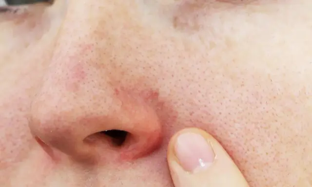 Gros plan sur un nez avec une légère rougeur autour des narines et des pores visibles. Un doigt effleure la peau.