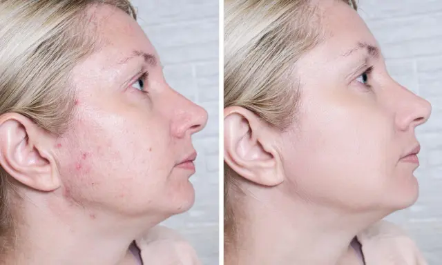 Przed i po: skóra z niedoskonałościami i zaczerwienieniami po zastosowaniu Acne Derm. Efekty widoczne!