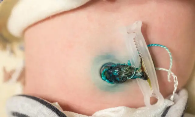 Piccolo granuloma ombelicale con clip e cordone residuo su pelle neonatale.