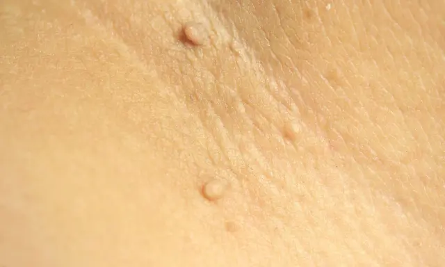 Gros plan sur une peau claire montrant plusieurs petites excroissances cutanées, certaines ressemblant à des grains de beauté ou des verrues.