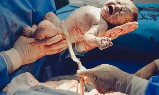 Noworodek po cesarskim cięciu, trzymany przez lekarza. Czy cesarskie cięcie boli? To pytanie zadaje wiele przyszłych mam.