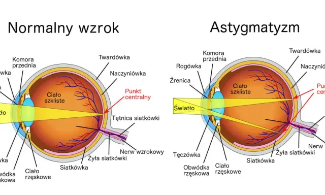 Porównanie budowy oka z normalnym wzrokiem i astygmatyzmem. Brak domowy sposób na astygmatyzm.