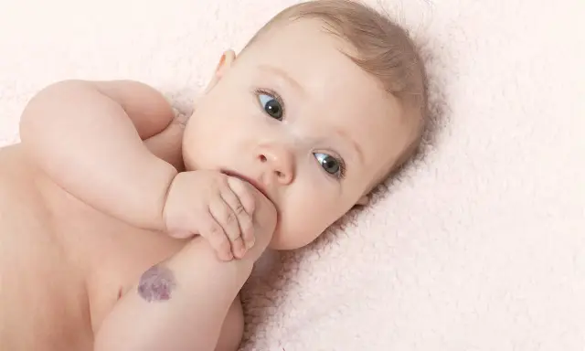 Bebé con un angioma en el brazo, mirando a la cámara con curiosidad.