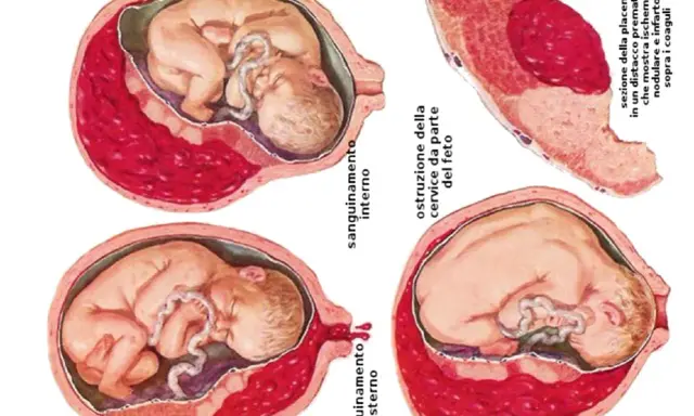 Illustrazioni mediche mostrano complicazioni della gravidanza: sanguinamento interno/esterno, ostruzione cervicale e distacco prematuro della placenta, evidenziando la placenta bassa.