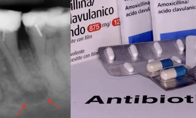 Radiografia dentale con segni di infezione e confezioni di amoxicillina/acido clavulanico, un antibiotico e antinfiammatorio.