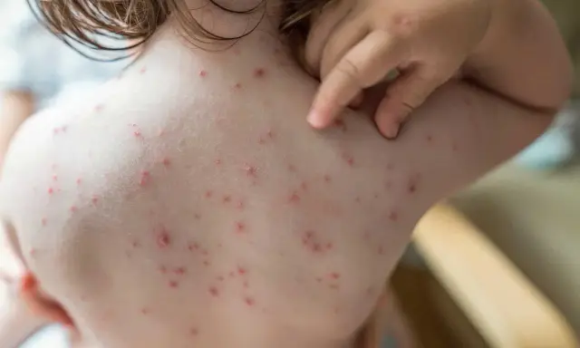 Un enfant se gratte le dos couvert de boutons de varicelle. Le traitement de la varicelle vise à soulager les démangeaisons.