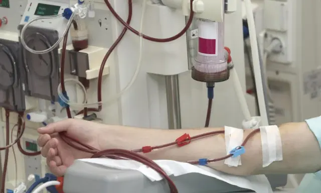 Dializa nerek jak długo można żyć? Pacjent podłączony do aparatury medycznej, krew krąży przez przewody.