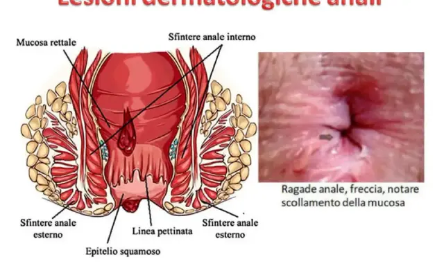 Illustrazione anatomica dell'ano e immagine ravvicinata di una ragade anale con freccia che indica lo scollamento della mucosa. Si notano puntini bianchi nell'area anale.