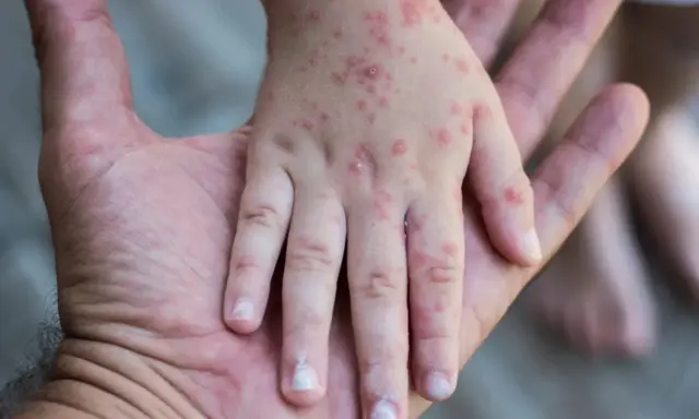 Mano de niño con erupciones rojas, síntoma de sarampión en niños, descansando sobre la mano de un adulto.