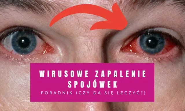 Czerwone, podrażnione oczy z widocznymi naczynkami. Tekst informuje o wirusowym zapaleniu spojówek i poradniku leczenia.