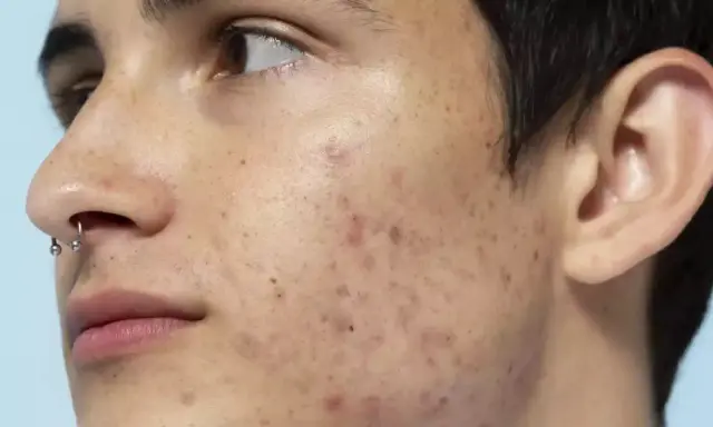 Primo piano del volto di un giovane con piercing al naso, che mostra le imperfezioni della pelle come brufoli e macchie.