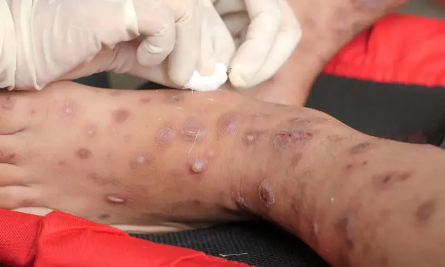 Mani guantate applicano un trattamento su una gamba affetta da scabbia. La temperatura ideale per uccidere la scabbia è di 50°C.