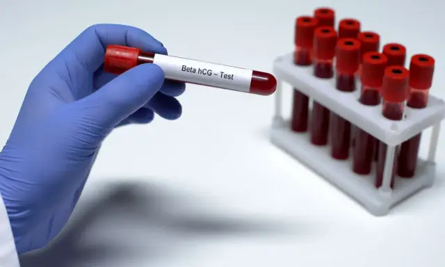 Ręka w niebieskiej rękawiczce trzyma probówkę z krwią do badania Beta hCG – test ciążowy z krwi. W tle stojak z innymi próbkami.