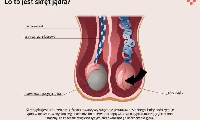 Ilustracja pokazuje skręt jądra, stanowiący przyczynę silnego bólu jądra, gdzie powrózek nasienny ulega skręceniu, blokując dopływ krwi.