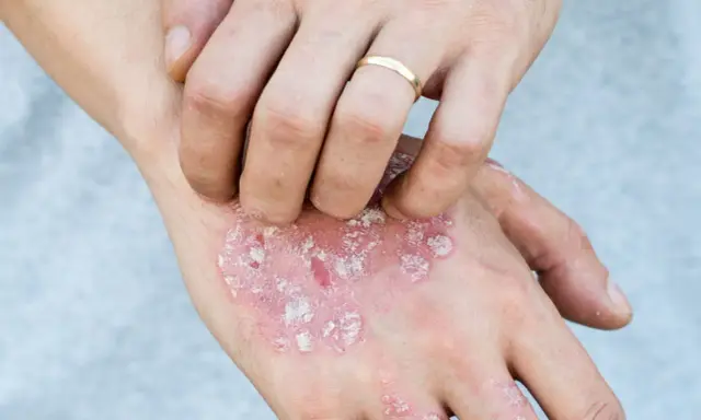 Main d'une personne se grattant des plaques rouges et squameuses, possiblement liées au psoriasis en goutte.