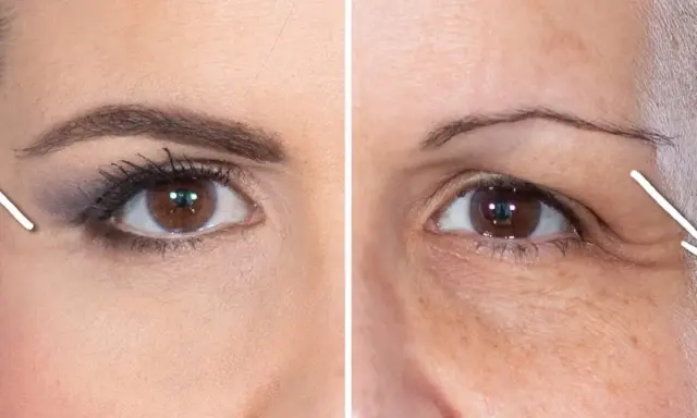 Comparaison avant/après : une jeune femme avec des sourcils bien dessinés et une femme plus âgée cherchant à remonter les sourcils naturellement.