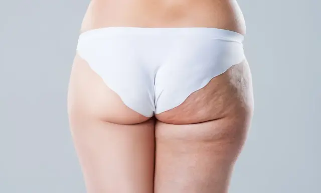 Vue arrière d'une femme en culotte blanche, montrant la cellulite sur sa cuisse.