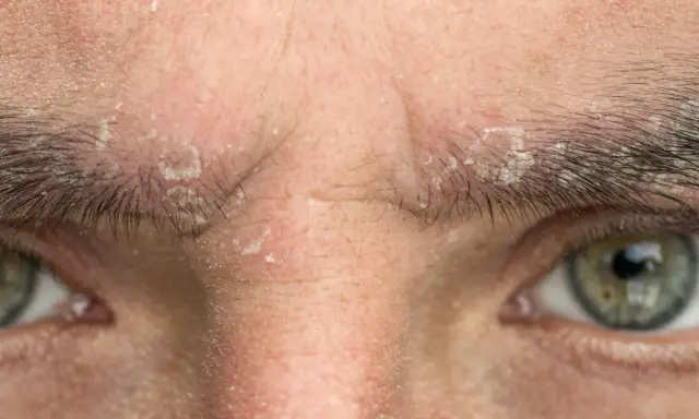 Gros plan sur un sourcil qui gratte et pèle, avec des squames blanches visibles sur la peau et entre les poils.