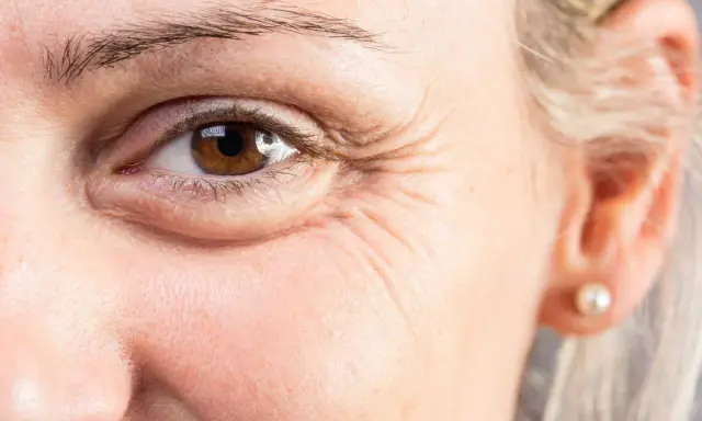 Gros plan sur un œil marron, avec des rides marquées. Une cuillère froide sur les yeux pour soulager les cernes.