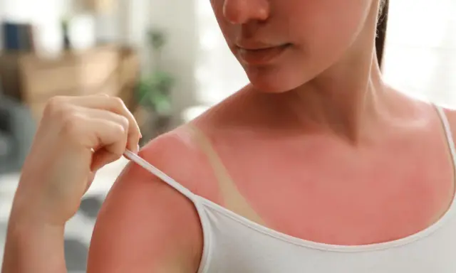 Épaule rouge vif, signe d'un coup de soleil. Une main tire la bretelle d'un débardeur blanc, révélant la peau brûlée par le soleil. Que mettre sur un coup de soleil ?
