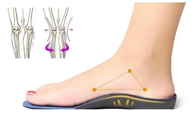 Un pied avec une semelle orthopédique, montrant le soutien. Le podologue utilise ces semelles pour corriger la posture.