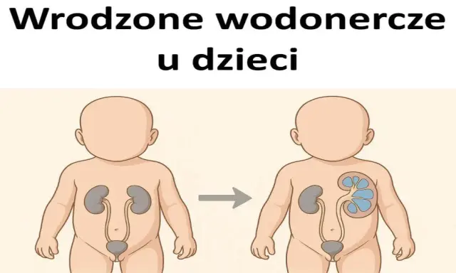 Ilustracja pokazuje rozwój wrodzonego wodonercza u noworodka. Po lewej zdrowa nerka, po prawej powiększona, z widocznymi zbiornikami moczu.