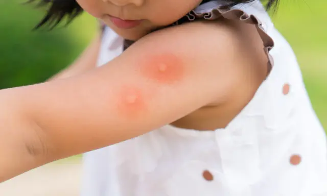Enfant avec une piqûre d'insecte sur le bras. Une huile essentielle pourrait soulager la démangeaison.