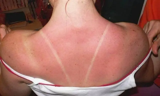 Dos lignes claires sur un dos rouge vif, témoignage d'un coup de soleil. Pour savoir comment faire dérougir un coup de soleil, il faut hydrater et apaiser la peau.