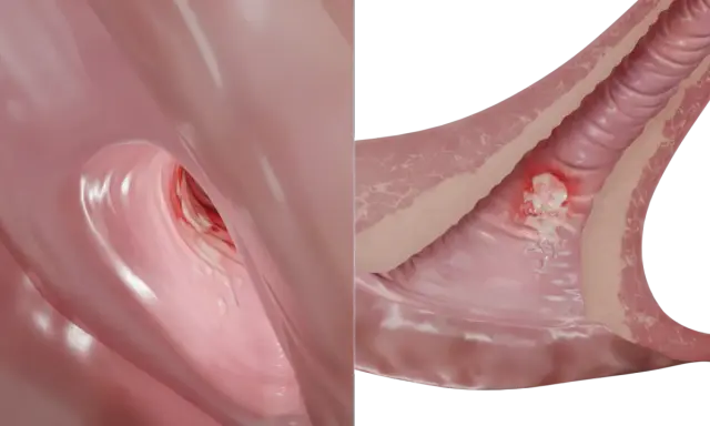 Representación de una llaga o chancro, síntoma temprano de la sífilis en mujeres.