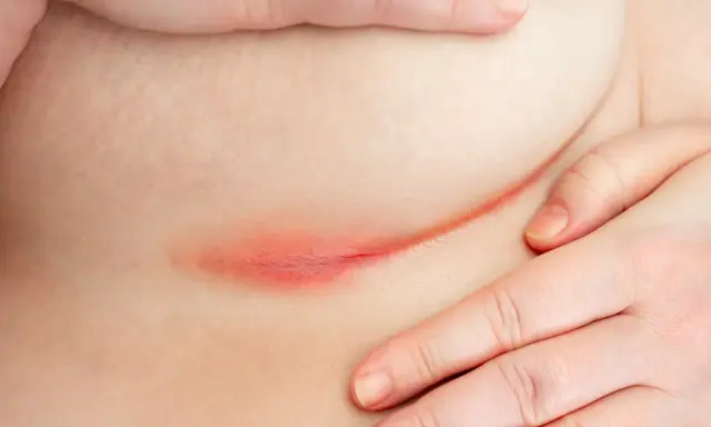 Irritazione cutanea sotto il seno, con rossore e possibile puzza dovuta all'umidità e al calore.