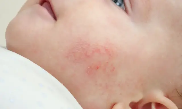 Un petit bouton rouge sur la joue d'un nourrisson, signe d'une peau sensible.