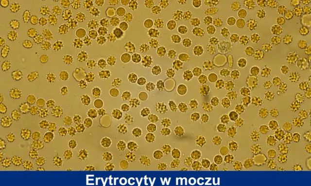 Mikroskopowy obraz moczu z licznymi erytrocytami, niektóre o zmienionym kształcie, sugerujące obecność leukocytów.