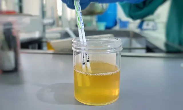 Testy paskowe zanurzone w próbce moczu, wskazujące na badanie pęcherza moczowego.
