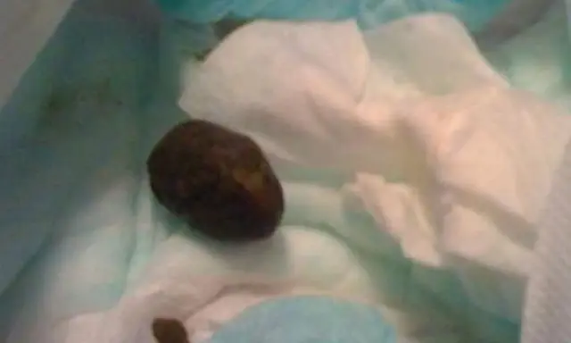 Babywindel mit hartem Stuhlgang in Form von Kugeln.