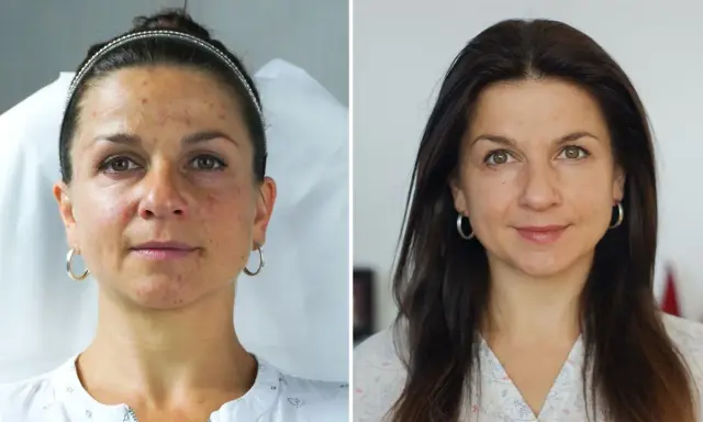 Porównanie twarzy kobiety przed i po zabiegu: skóra z niedoskonałościami i po wygładzeniu.