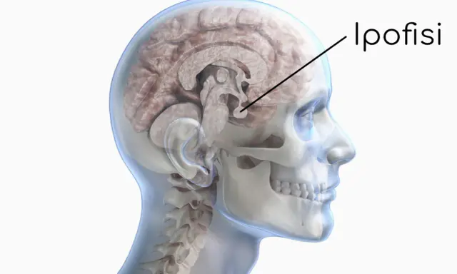 Sezione del cervello umano che evidenzia l'ipofisi. Un tumore ipofisi sintomi può manifestarsi con disturbi visivi o ormonali.