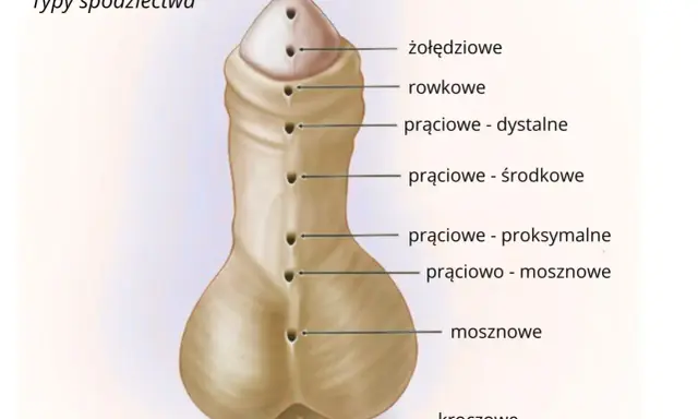 Ilustracja przedstawia typy spodziectwa, czyli wady rozwojowe cewki moczowej. Różne lokalizacje ujścia cewki mogą wpływać na obniżenie cewki moczowej objawy.
