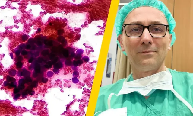 Mikroskopowe obrazy komórek rakowych i lekarz w zielonym fartuchu. Czy czwarte stadium raka ile trwa?