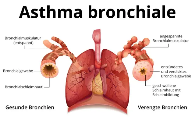 Vergleich gesunder und verengter Bronchien bei Asthma. Symptome wie angespannte Muskulatur und Schleimbildung führen zu Atemnot.