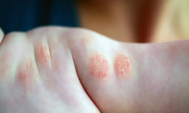 Plaques rouges et squameuses sur le bras d'un enfant, signe d'un petit bouton sur les bras allergie.