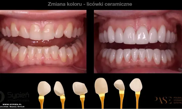 Przed i po metamorfozie zębów: od naturalnego koloru do olśniewającego, hollywoodzki uśmiech dzięki licówkom ceramicznym.