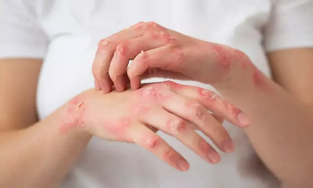 Mains atteintes de plaques rouges et squameuses, signe d'un psoriasis. La cause exacte reste complexe.