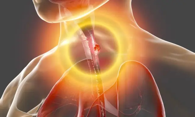 Cáncer de esófago: síntomas clave que no debes ignorar. ¿Los conoces?