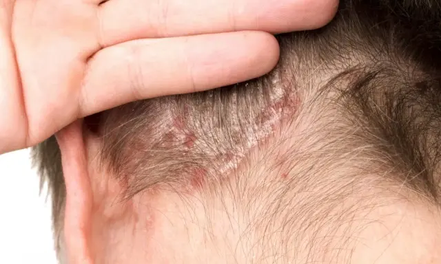 Main d'une personne touchant son cuir chevelu, révélant des plaques rouges et des squames cheveux.
