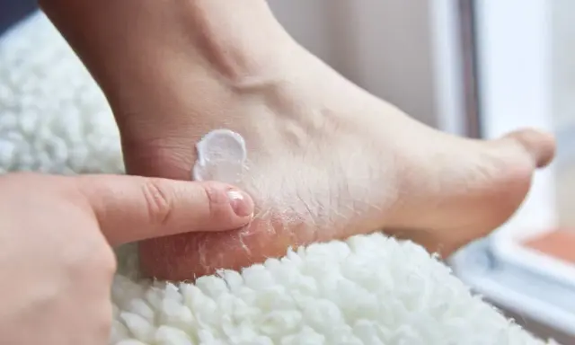Application d'une crème pour soigner une crevasse au talon, un conseil de podologue pour retrouver des pieds doux.