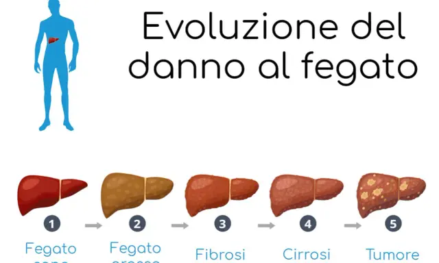 Illustrazione mostra l'evoluzione del danno al fegato: da sano a grasso, fibrosi, cirrosi e tumore.